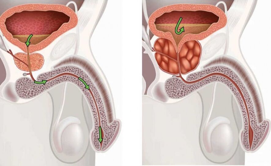 rășină de cedru pentru prostatită urinarea nocturnă la bărbații cu prostatită