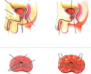 нормална простата и хроничен простатит
