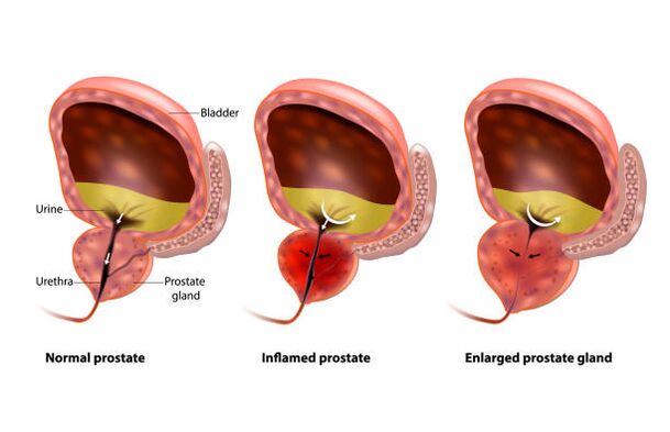 простатитът е възпаление на простатната жлеза