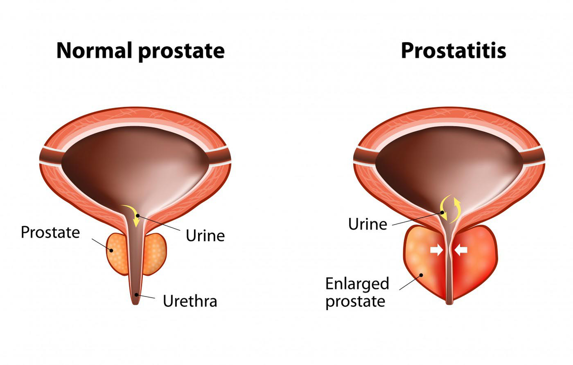 Нормална простата на здрав мъж и възпаление на простатната жлеза при простатит