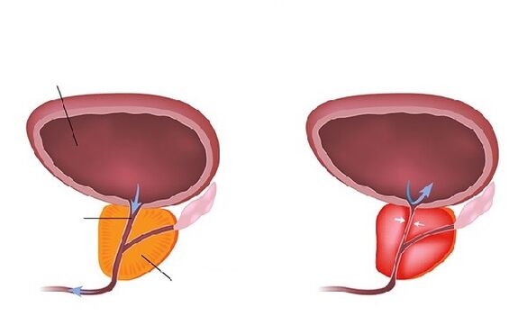нормална и възпалена простата